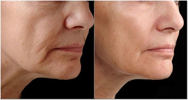 Rejuvenation before and after laser