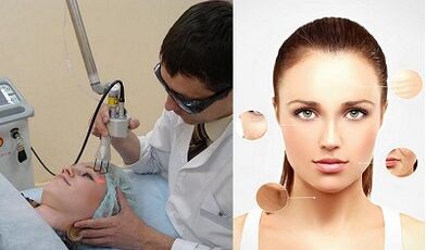 How is laser skin resurfacing performed