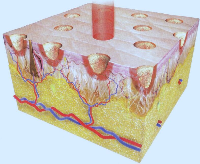 The laser burns part of the skin cells, forcing their environment to increase regeneration. 