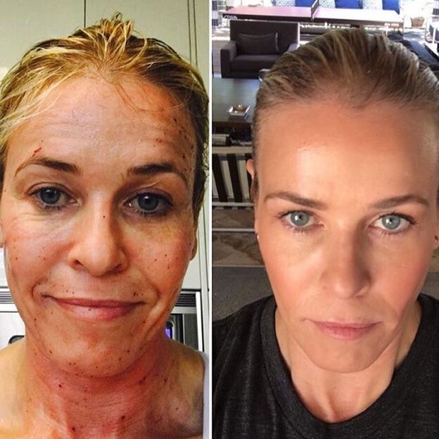 Woman before and after fractional laser (get rid of hyperpigmentation foci)